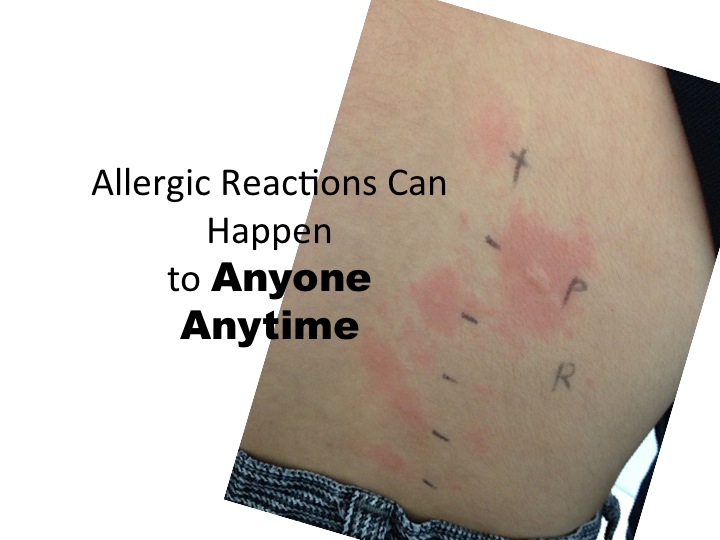 Discovering Allergies Food Allergies Can Happen Anytime